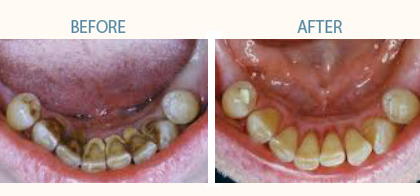 Can Teeth Fall Out After Getting a Deep Cleaning?