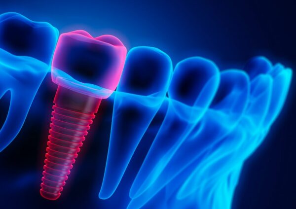 Dental Implant