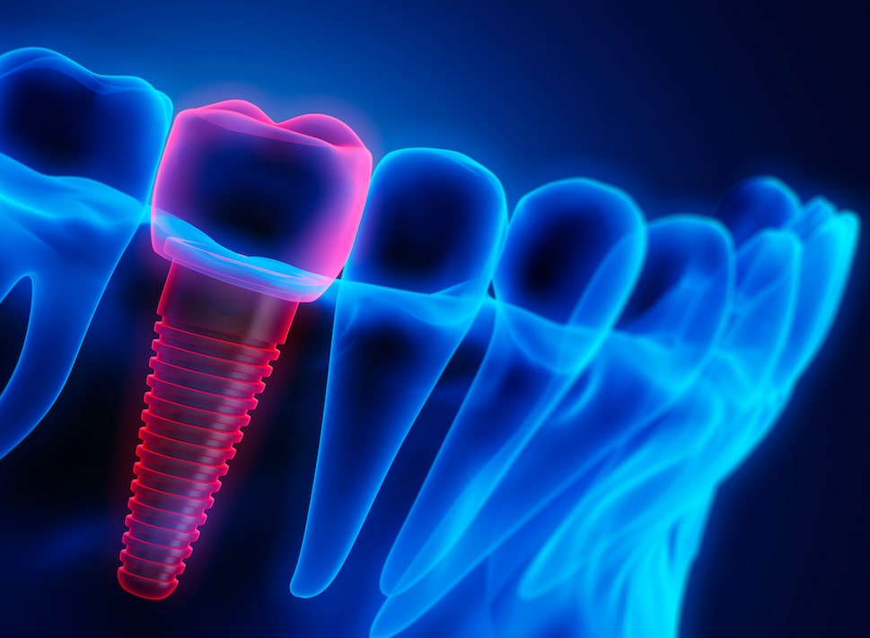 How Can Dental Implants Restore Your Natural Smile Fairfax, VA 22030