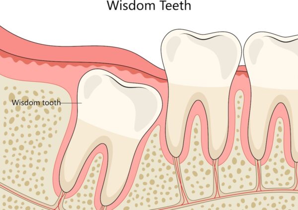 wisdom teeth 2
